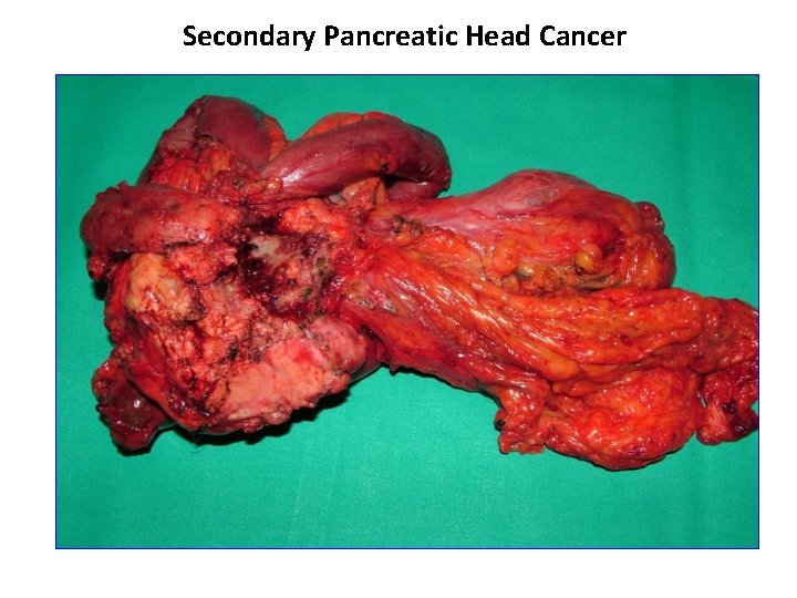 Secondary Pancreatic Head Cancer 