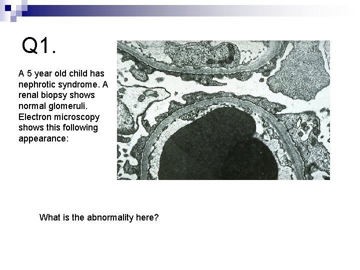 Q 1. A 5 year old child has nephrotic syndrome. A renal biopsy shows