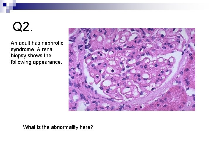 Q 2. An adult has nephrotic syndrome. A renal biopsy shows the following appearance.