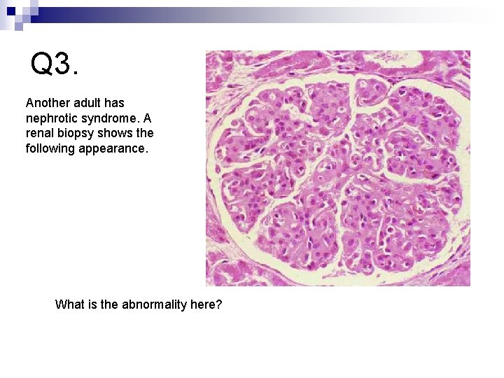 Q 3. Another adult has nephrotic syndrome. A renal biopsy shows the following appearance.