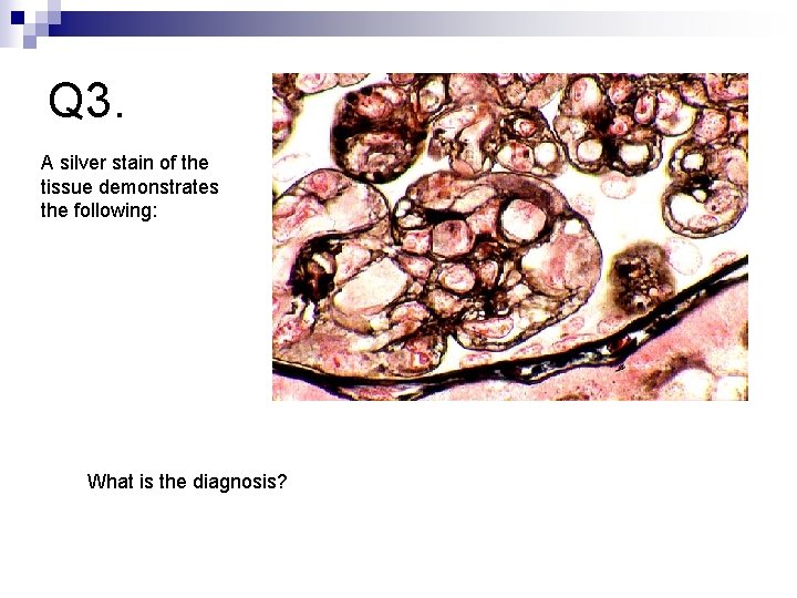 Q 3. A silver stain of the tissue demonstrates the following: What is the