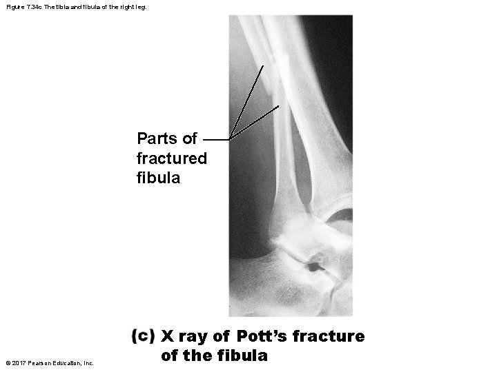 Figure 7. 34 c The tibia and fibula of the right leg. Parts of