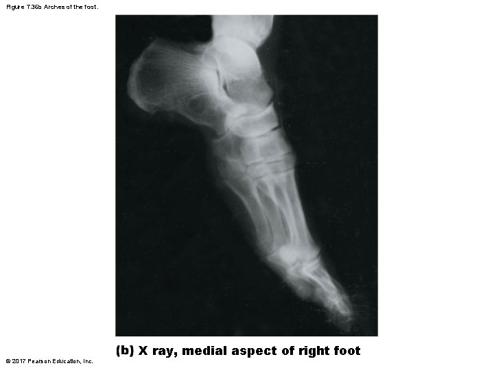 Figure 7. 36 b Arches of the foot. © 2017 Pearson Education, Inc. X