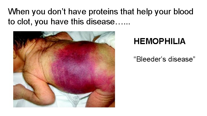 When you don’t have proteins that help your blood to clot, you have this
