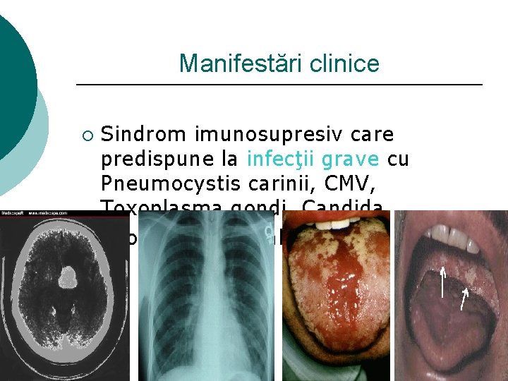 Manifestări clinice Sindrom imunosupresiv care predispune la infecţii grave cu Pneumocystis carinii, CMV, Toxoplasma