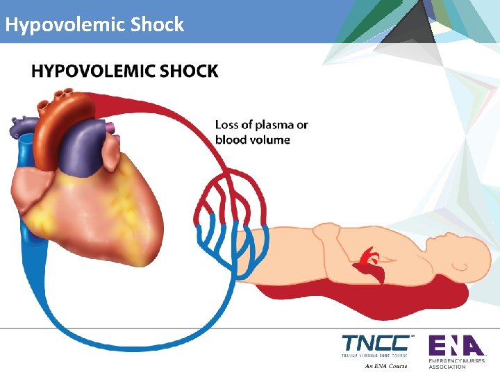 Hypovolemic Shock 