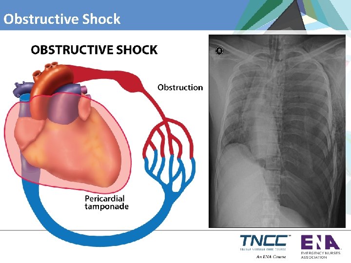 Obstructive Shock 