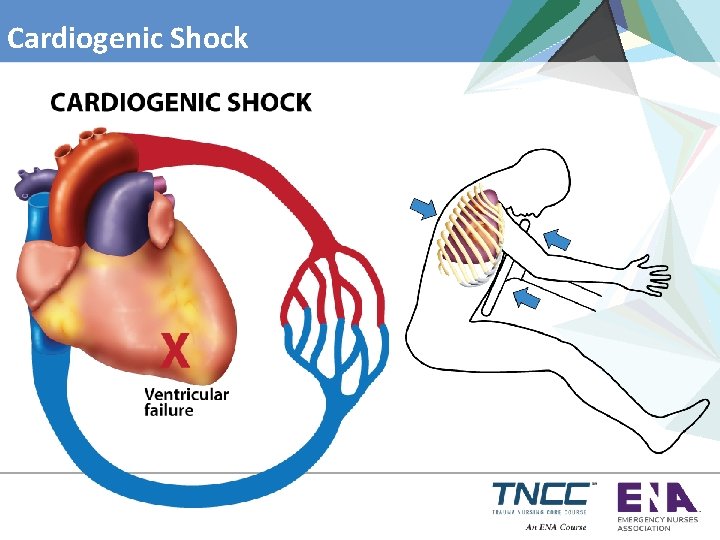 Cardiogenic Shock 