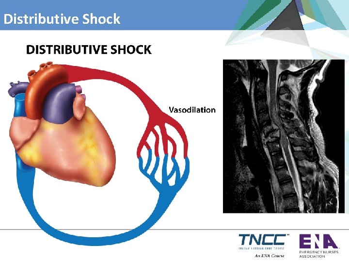 Distributive Shock 