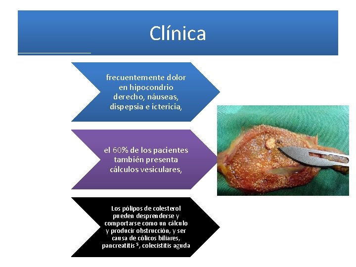 Clínica frecuentemente dolor en hipocondrio derecho, náuseas, dispepsia e ictericia, el 60% de los