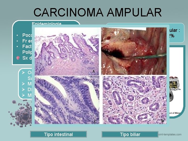 CARCINOMA AMPULAR Epidemiologia • Poco común 2% CA TGI • Fr en 7ª década