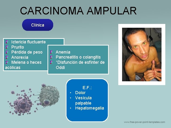 CARCINOMA AMPULAR Clínica Ictericia fluctuante Prurito Pérdida de peso Anorexia Melena o heces acólicas