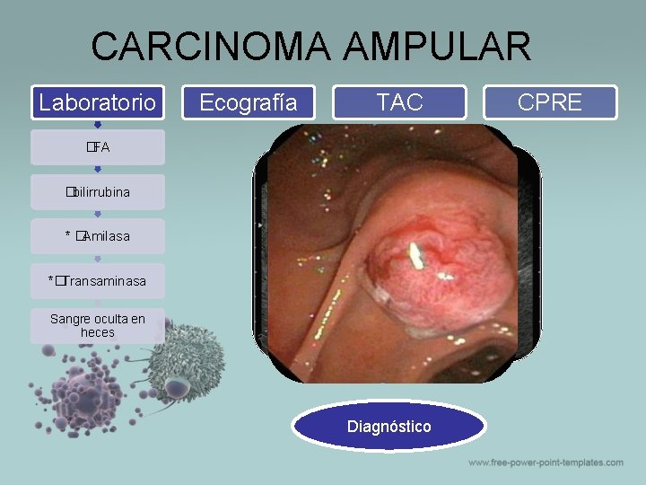 CARCINOMA AMPULAR Laboratorio Ecografía TAC �FA �bilirrubina * �Amilasa *�Transaminasa Sangre oculta en heces