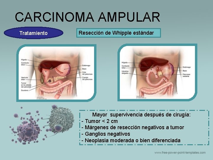 CARCINOMA AMPULAR Tratamiento Resección de Whipple estándar Mayor supervivencia después de cirugía: - Tumor