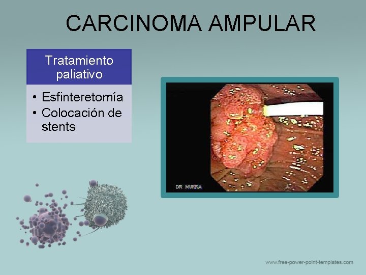 CARCINOMA AMPULAR Tratamiento paliativo • Esfinteretomía • Colocación de stents 
