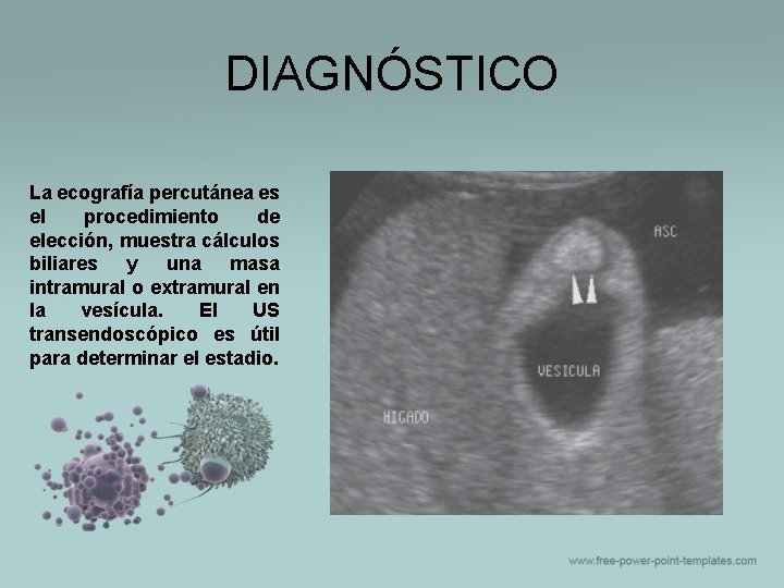 DIAGNÓSTICO La ecografía percutánea es el procedimiento de elección, muestra cálculos biliares y una