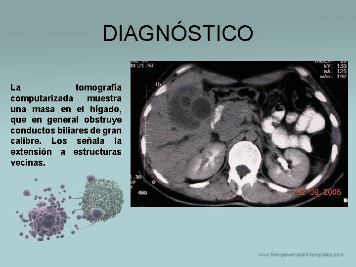 DIAGNÓSTICO La tomografía computarizada muestra una masa en el hígado, que en general obstruye