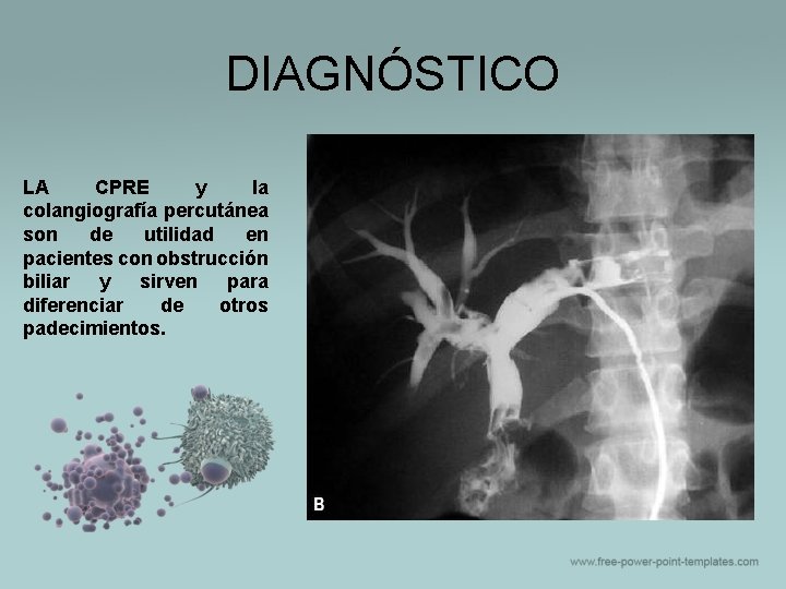 DIAGNÓSTICO LA CPRE y la colangiografía percutánea son de utilidad en pacientes con obstrucción