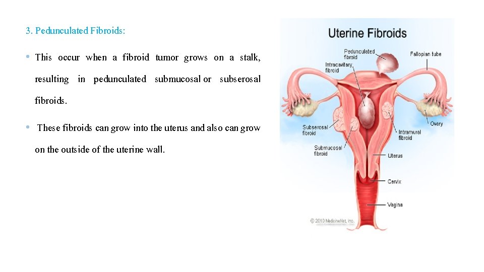 3. Pedunculated Fibroids: • This occur when a fibroid tumor grows on a stalk,