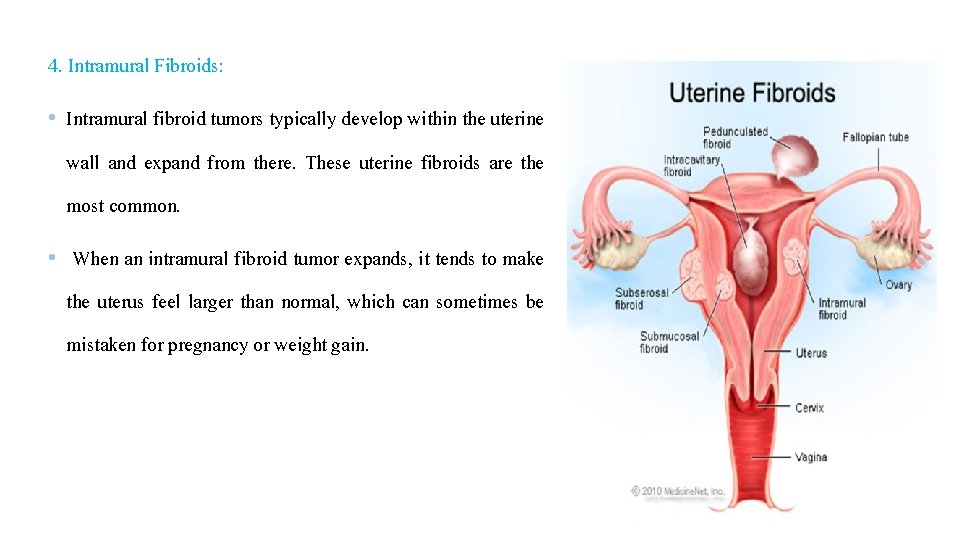 4. Intramural Fibroids: • Intramural fibroid tumors typically develop within the uterine wall and