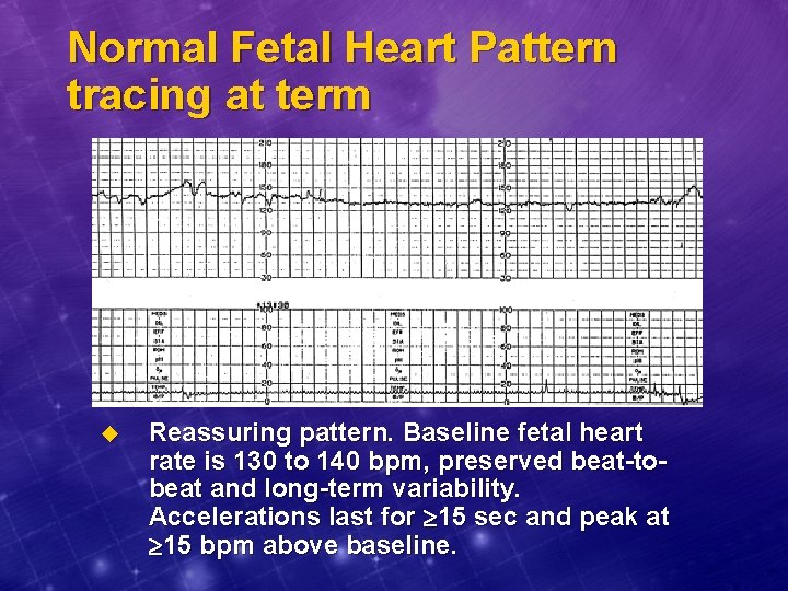 Normal Fetal Heart Pattern tracing at term u Reassuring pattern. Baseline fetal heart rate