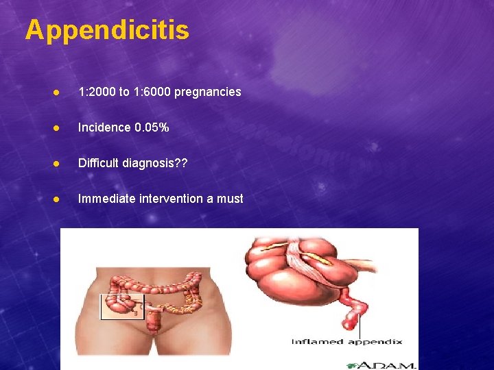 Appendicitis l 1: 2000 to 1: 6000 pregnancies l Incidence 0. 05% l Difficult