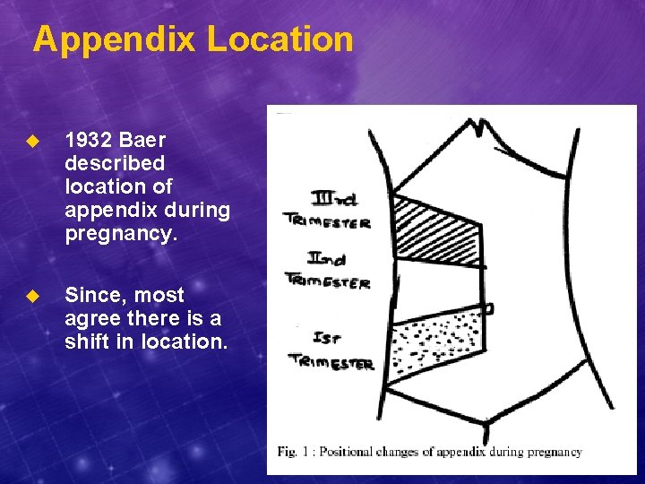 Appendix Location u 1932 Baer described location of appendix during pregnancy. u Since, most