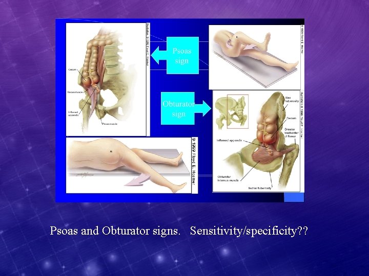 Psoas and Obturator signs. Sensitivity/specificity? ? 