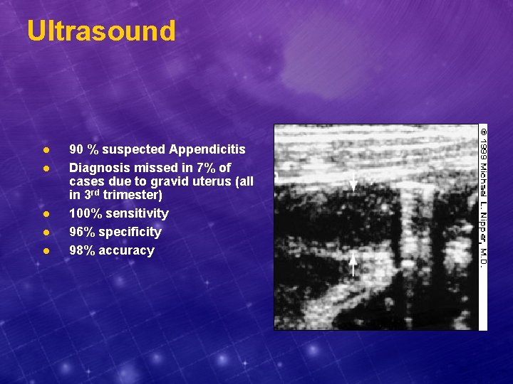 Ultrasound l l l 90 % suspected Appendicitis Diagnosis missed in 7% of cases