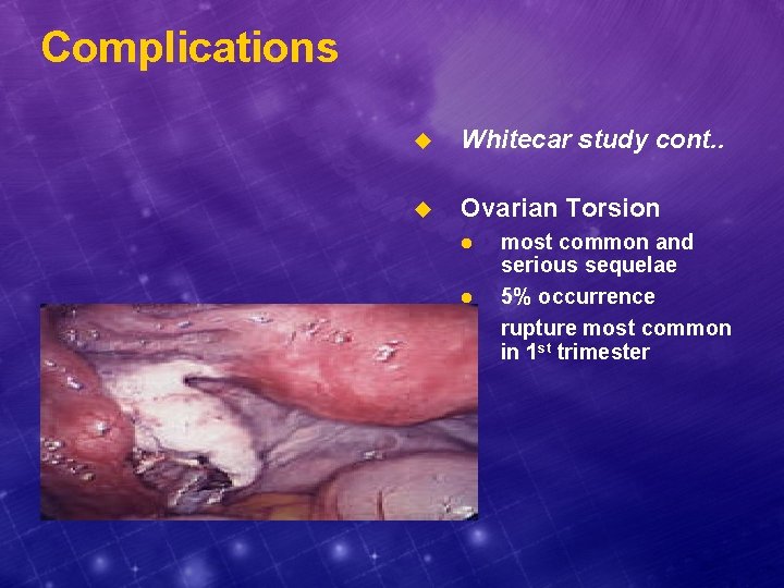 Complications u Whitecar study cont. . u Ovarian Torsion l l l most common