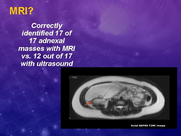 MRI? Correctly identified 17 of 17 adnexal masses with MRI vs. 12 out of