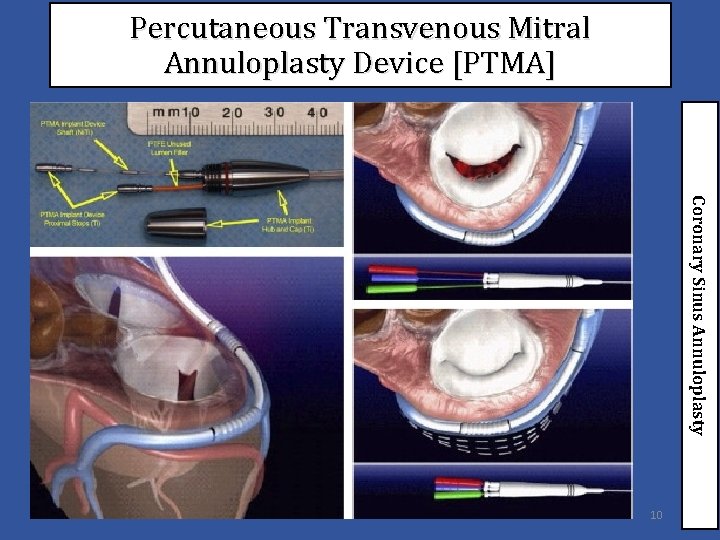 Percutaneous Transvenous Mitral Annuloplasty Device [PTMA] Coronary Sinus Annuloplasty 10 