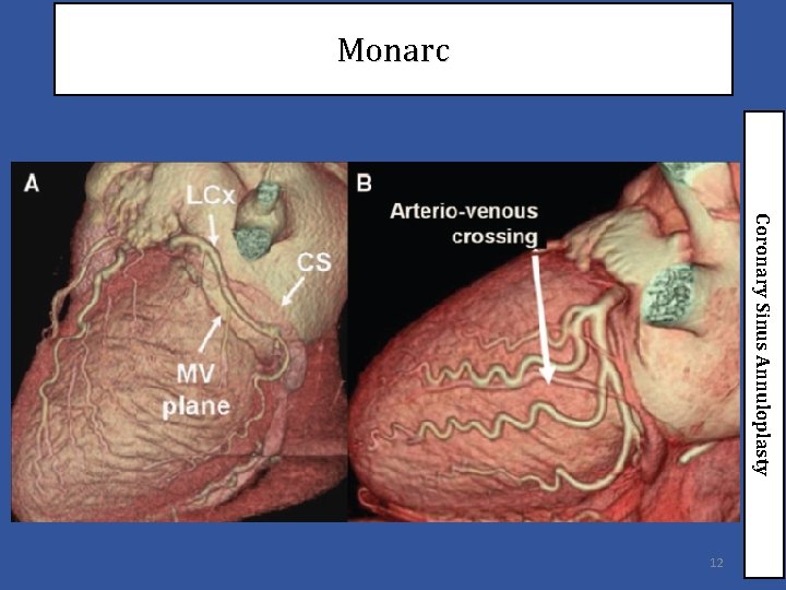 Monarc Coronary Sinus Annuloplasty 12 