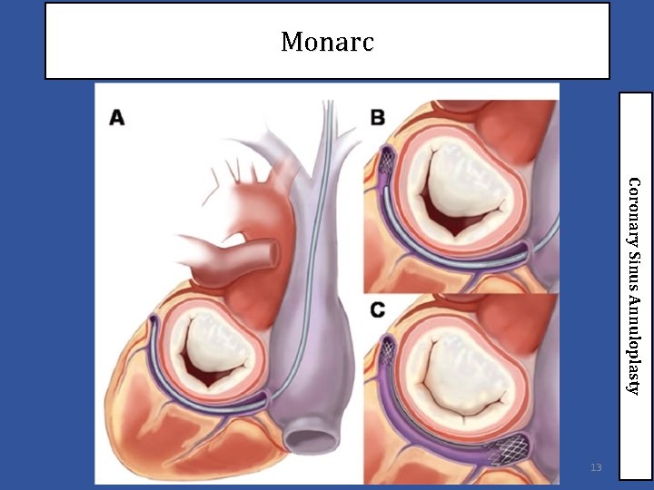 Monarc Coronary Sinus Annuloplasty 13 