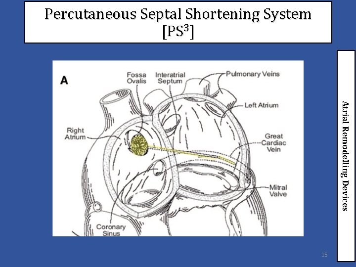 Percutaneous Septal Shortening System [PS 3] Atrial Remodelling Devices 15 