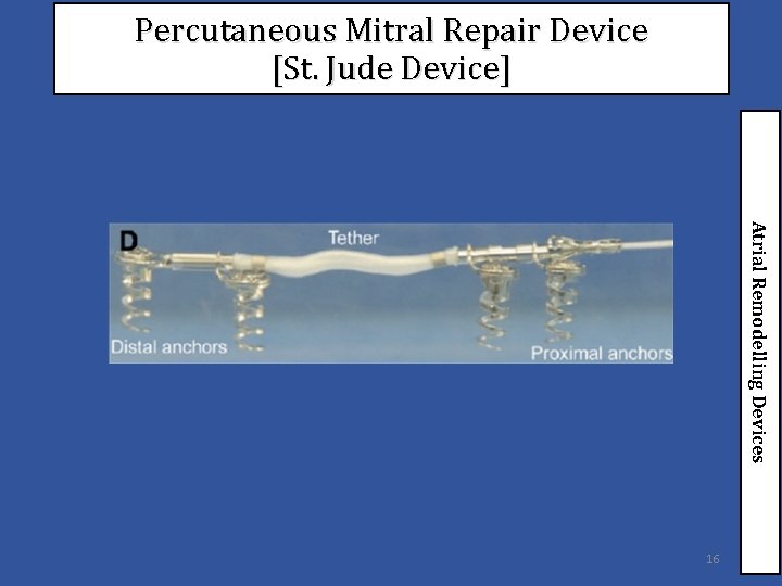 Percutaneous Mitral Repair Device [St. Jude Device] Atrial Remodelling Devices 16 