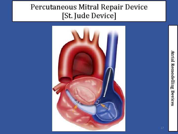 Percutaneous Mitral Repair Device [St. Jude Device] Atrial Remodelling Devices 17 