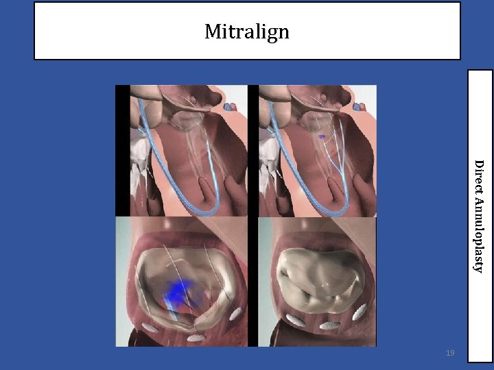 Mitralign Direct Annuloplasty 19 