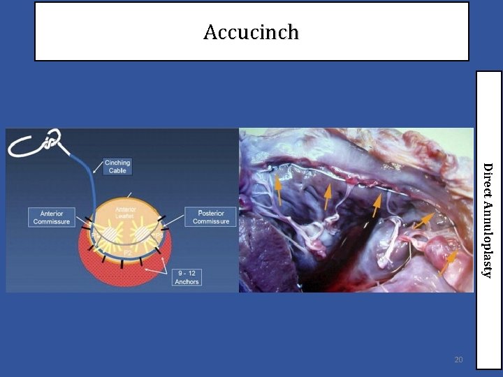 Accucinch Direct Annuloplasty 20 