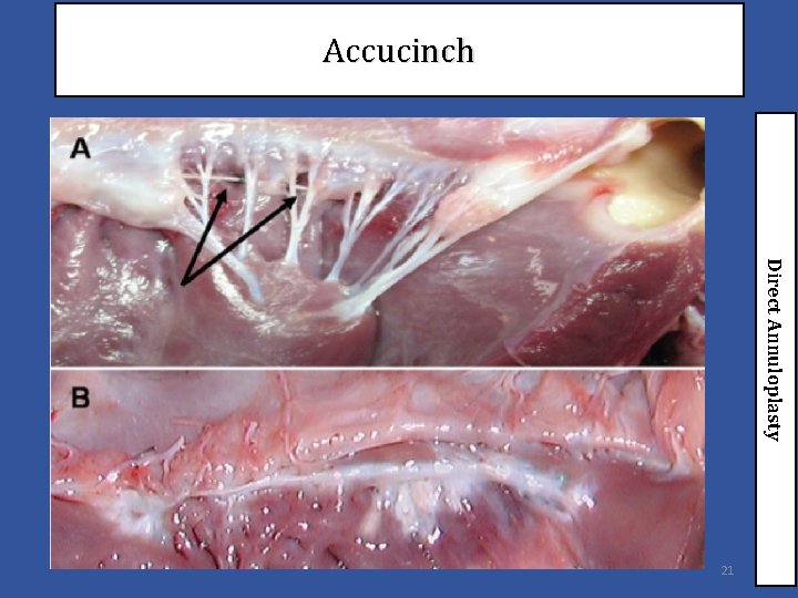 Accucinch Direct Annuloplasty 21 
