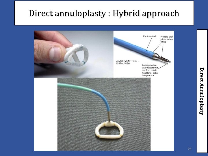 Direct annuloplasty : Hybrid approach Direct Annuloplasty 23 