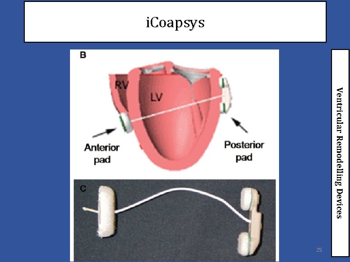 i. Coapsys Ventricular Remodelling Devices 25 