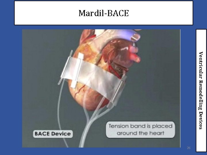 Mardil-BACE Ventricular Remodelling Devices 26 