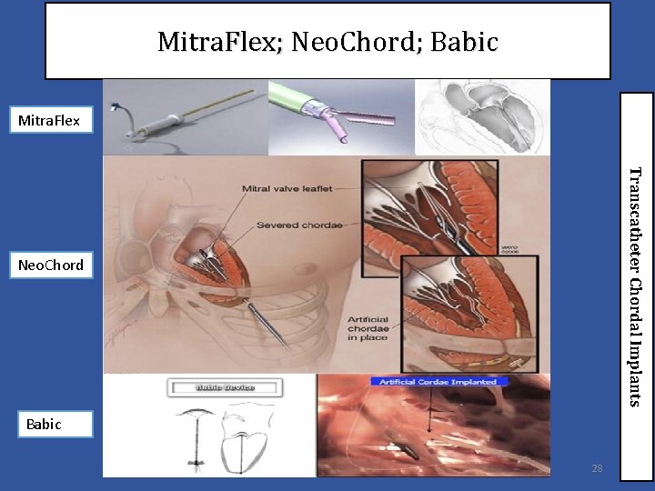 Mitra. Flex; Neo. Chord; Babic Mitra. Flex Transcatheter Chordal Implants Neo. Chord Babic 28