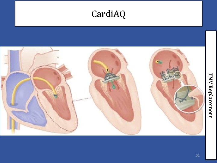 Cardi. AQ TMV Replacement 31 