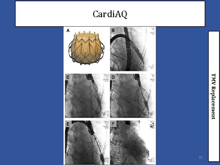 Cardi. AQ TMV Replacement 32 