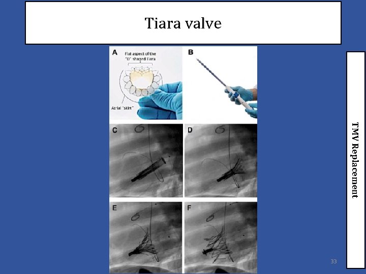 Tiara valve TMV Replacement 33 