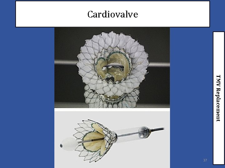 Cardiovalve TMV Replacement 37 