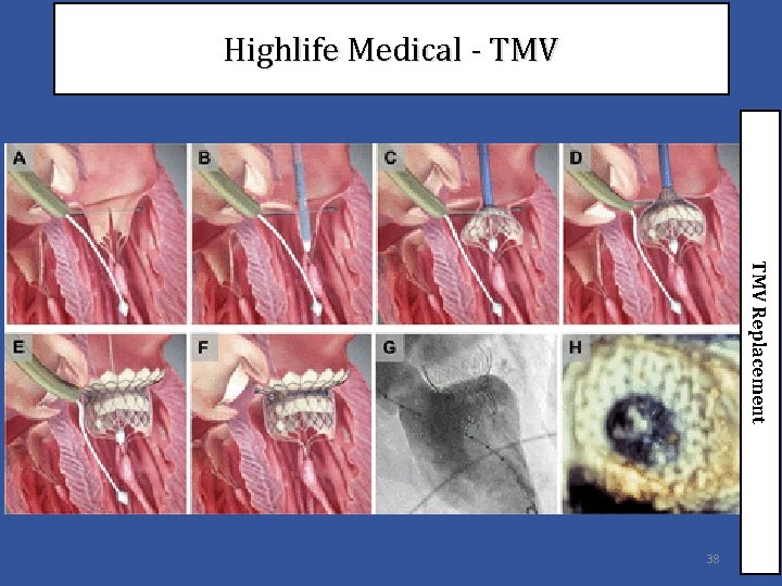 Highlife Medical - TMV Replacement 38 