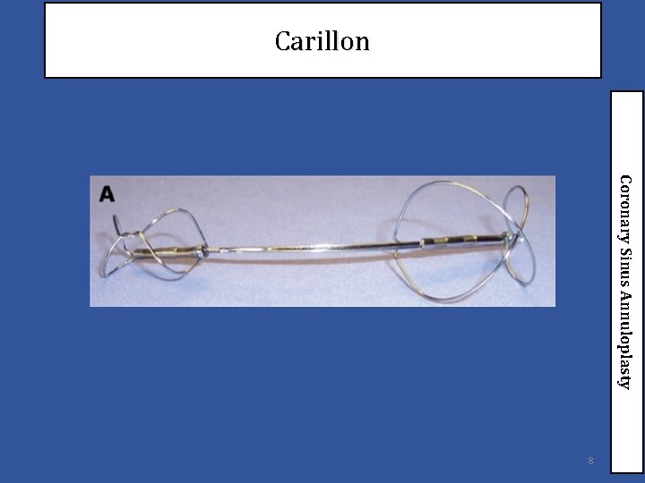 Carillon Coronary Sinus Annuloplasty 8 